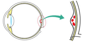 稀に起こる合併症:嚢胞様黄斑浮腫