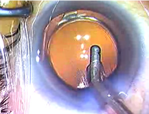 6.眼粘弾剤除去&創口閉鎖