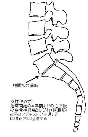 椎間板の萎縮