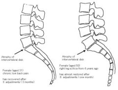 Atrophy of the disk