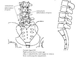 Osteophyte