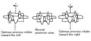 Rotation of the vertebra