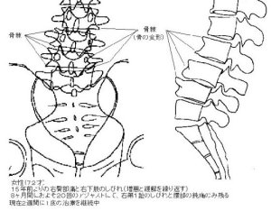 椎骨の変形(骨棘)