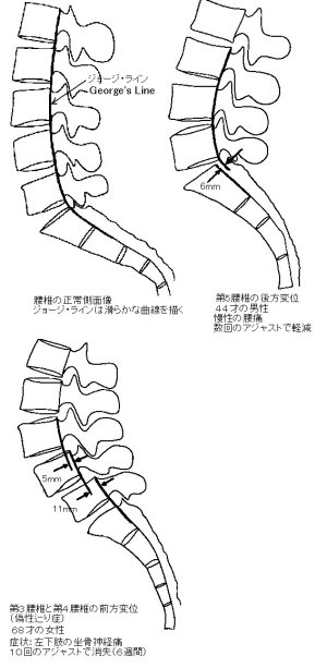 椎骨の後方変位