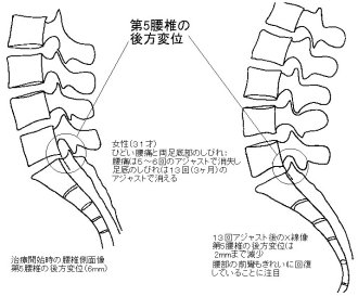 腰椎の後方変位