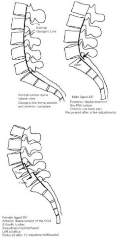 Posterior Displacement