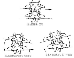 椎骨の傾き変位