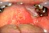 herpes2img0018.jpg