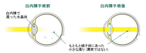 術後に見られる症状：飛蚊症