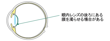 術後に見られる症状：後発白内障