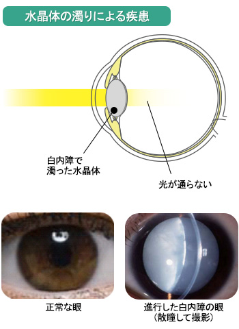 白内障とは水晶体の異常