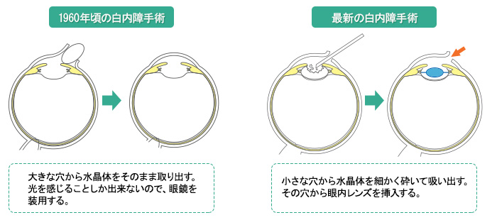 白内障手術の変遷