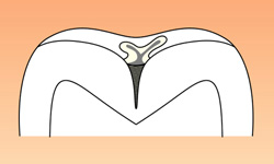 シーラントイラスト