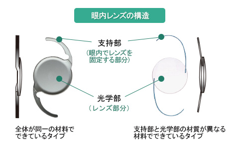 眼内レンズの構造