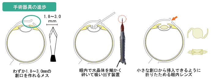 手術器具の進歩