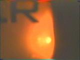 ER