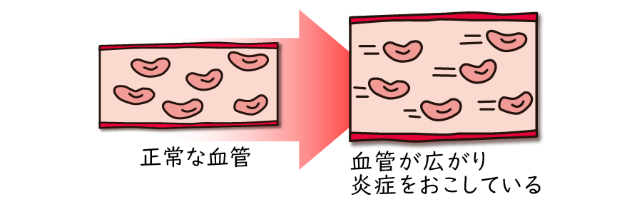 片頭痛