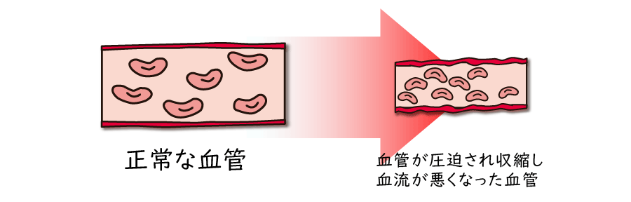 緊張型頭痛