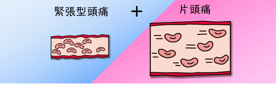 混合型頭痛