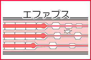 顔面神経麻痺：後遺症のけいれん