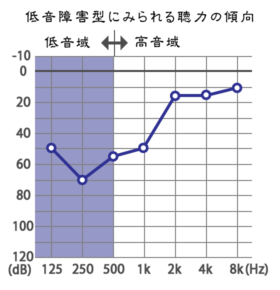 低音障害型難聴