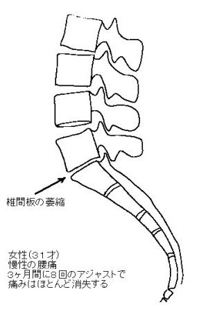 椎間板の萎縮