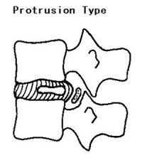 protruded disk