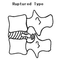 ruptured disk