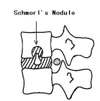 schmorl's nodule