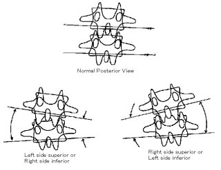 Tilt of the vertebra