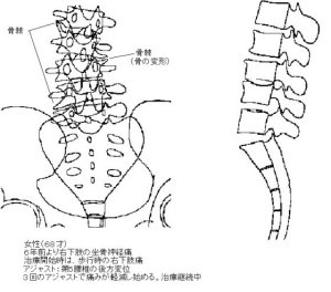 椎骨の変形(骨棘)