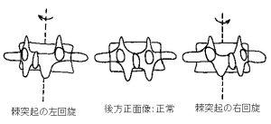 椎骨の回旋変位