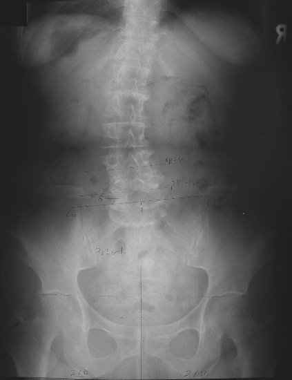 xray13