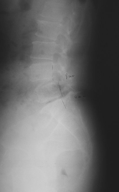 xray15