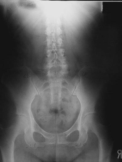 xray17