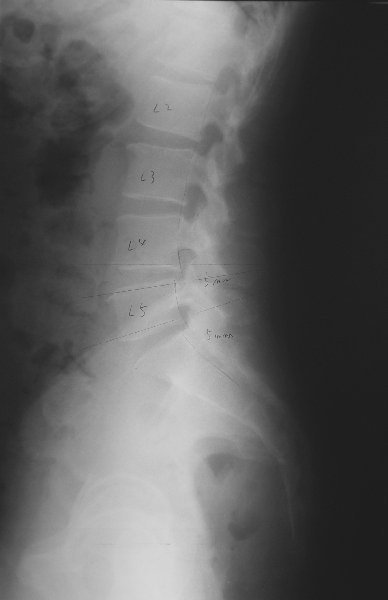 xray22