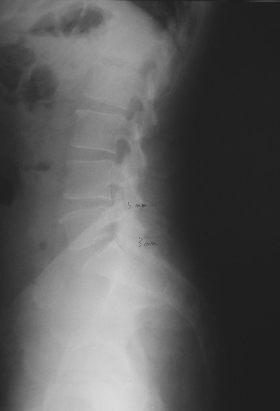 xray23