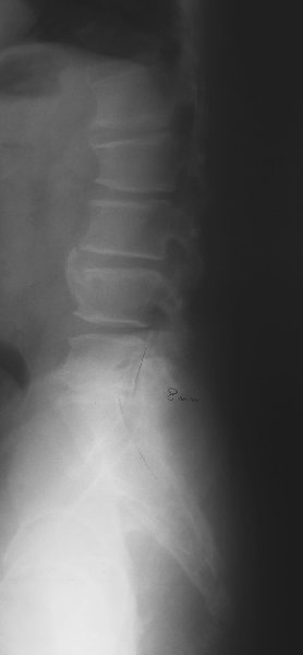 xray30