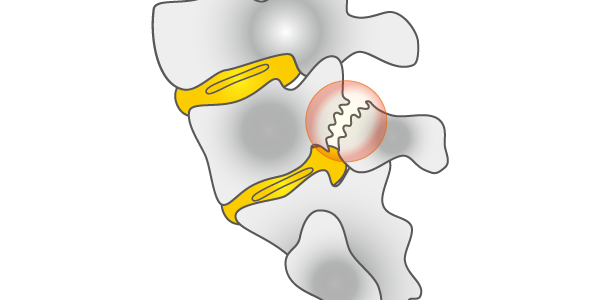 腰椎分離症の治療