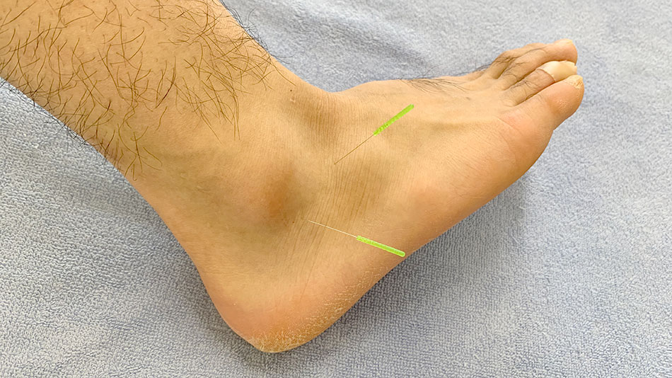 足首捻挫の鍼灸治療