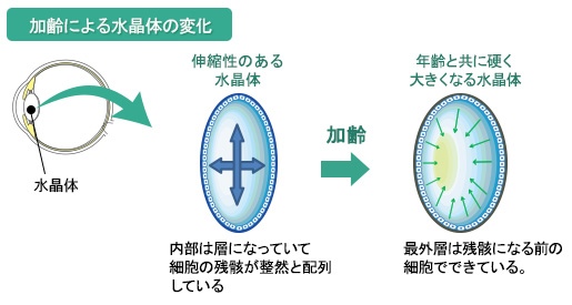 加齢による水晶体の変化