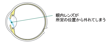 稀に起こる合併症：眼内レンズの偏位