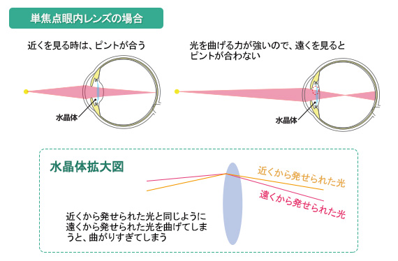 単焦点眼内レンズの場合