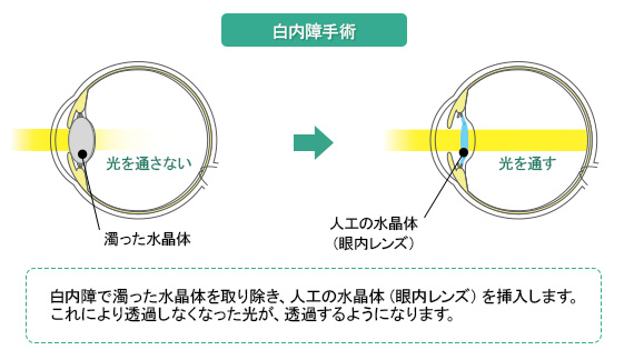 白内障の治療 手術 白内障と白内障手術