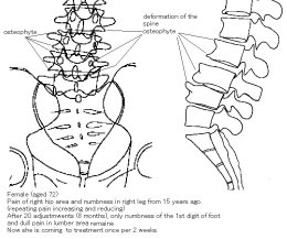 Osteophyte