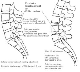 Posterior Displacement