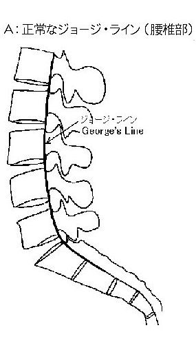 腰椎の後方変位